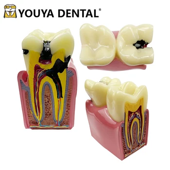 שיניים המודל העששת השוואה למודל שיניים טכנאי הוראה תרגול לומדת רפואת שיניים כלים